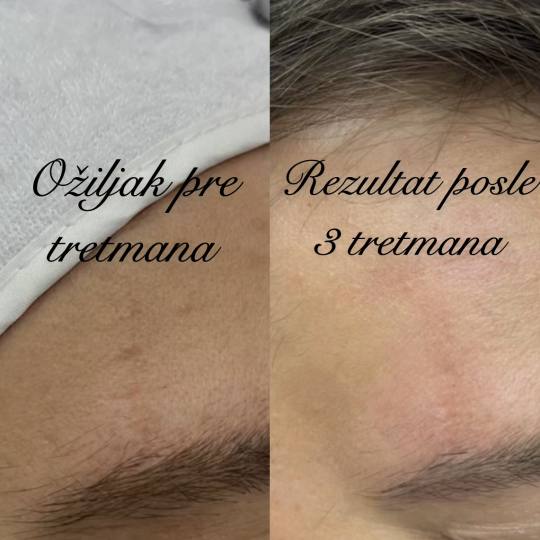Estetski centar Vlahović #beograd Dermaroler i dermapen Dermapen - ožiljci od akni