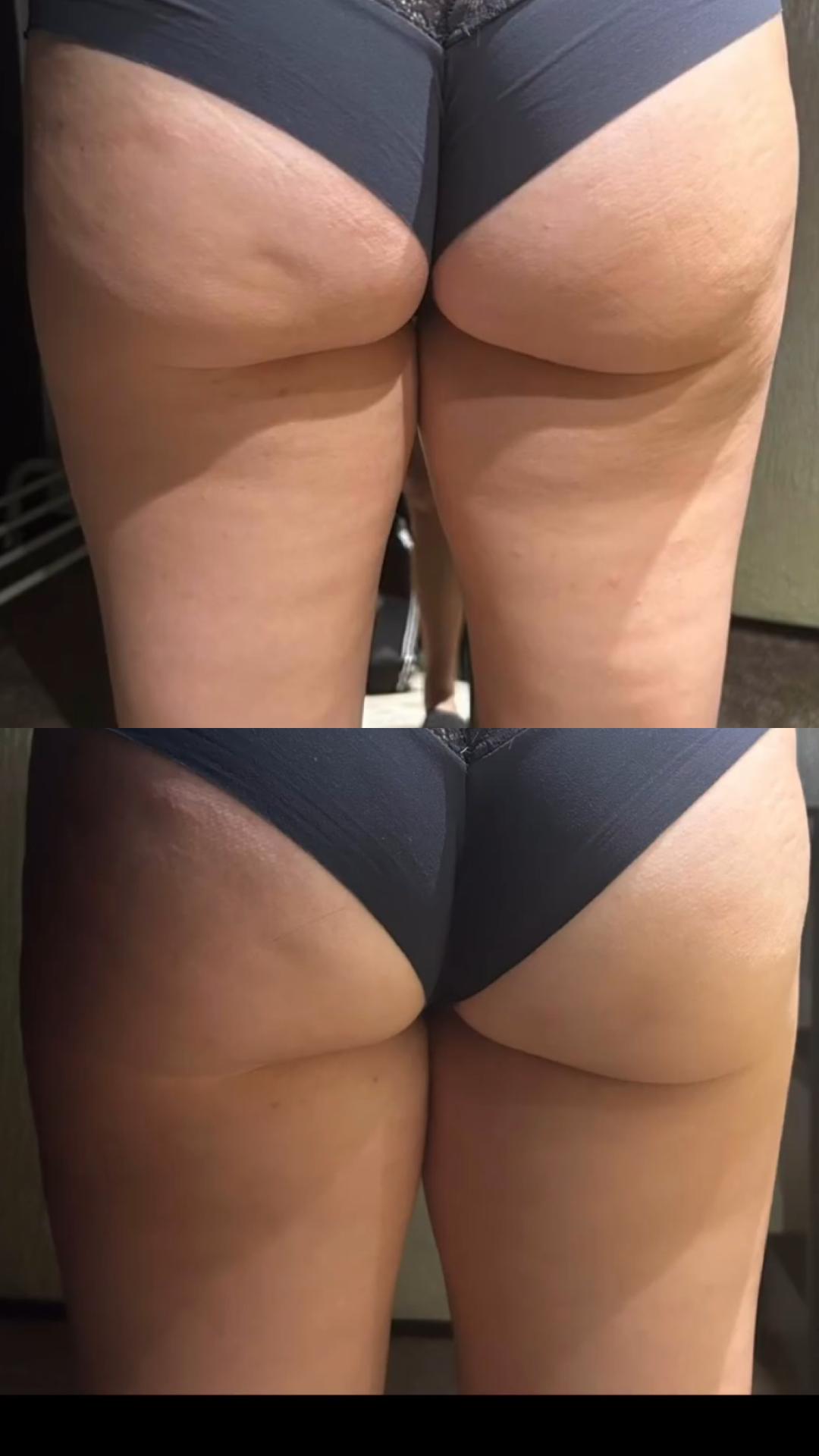 Belle Ana #beograd Tretmani tela Body top tretman 2 regije + anticelulitna masaža