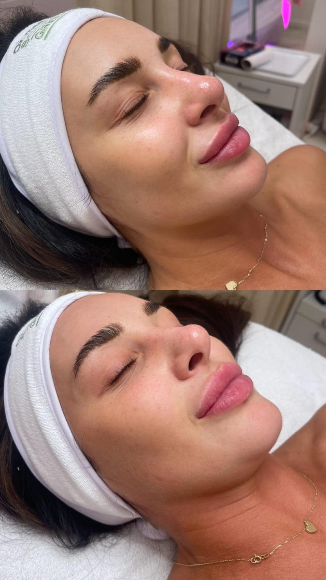 Choco Love #beograd Tretman lica PRX therapy