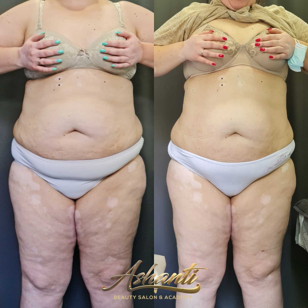Ashanti Beauty Salon & Academy #beograd Tretmani za mršavljenje Vacuslim 48 - noge + stomak + ruke - paket od 5 tretmana