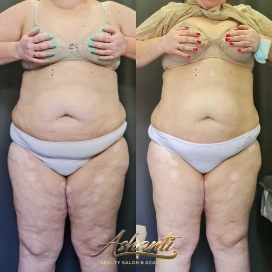 Ashanti Beauty Salon & Academy #beograd Tretmani za mršavljenje Vacuslim 48 - noge + stomak + ruke 
