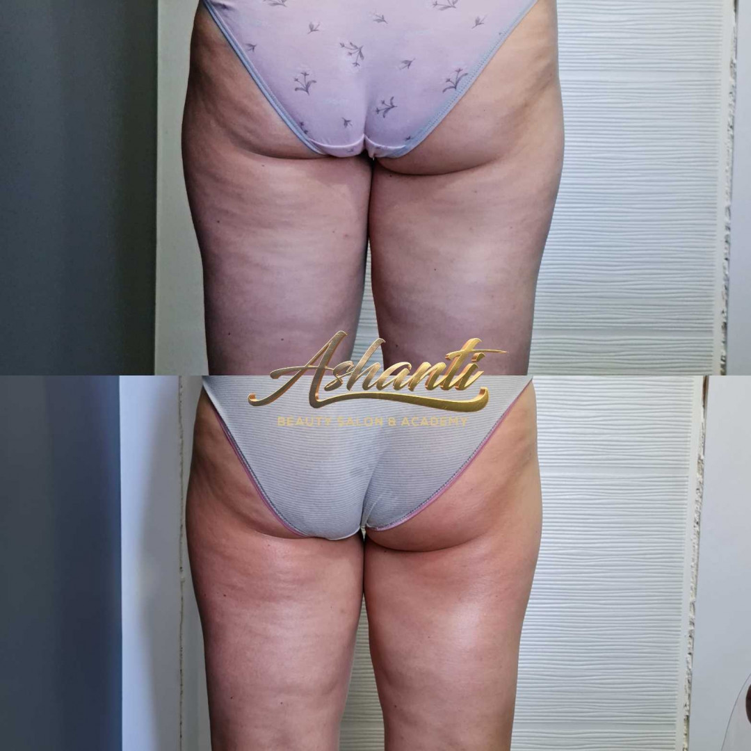 Ashanti Beauty Salon & Academy #beograd Masaža za mršavljenje Dermapen - regija lica