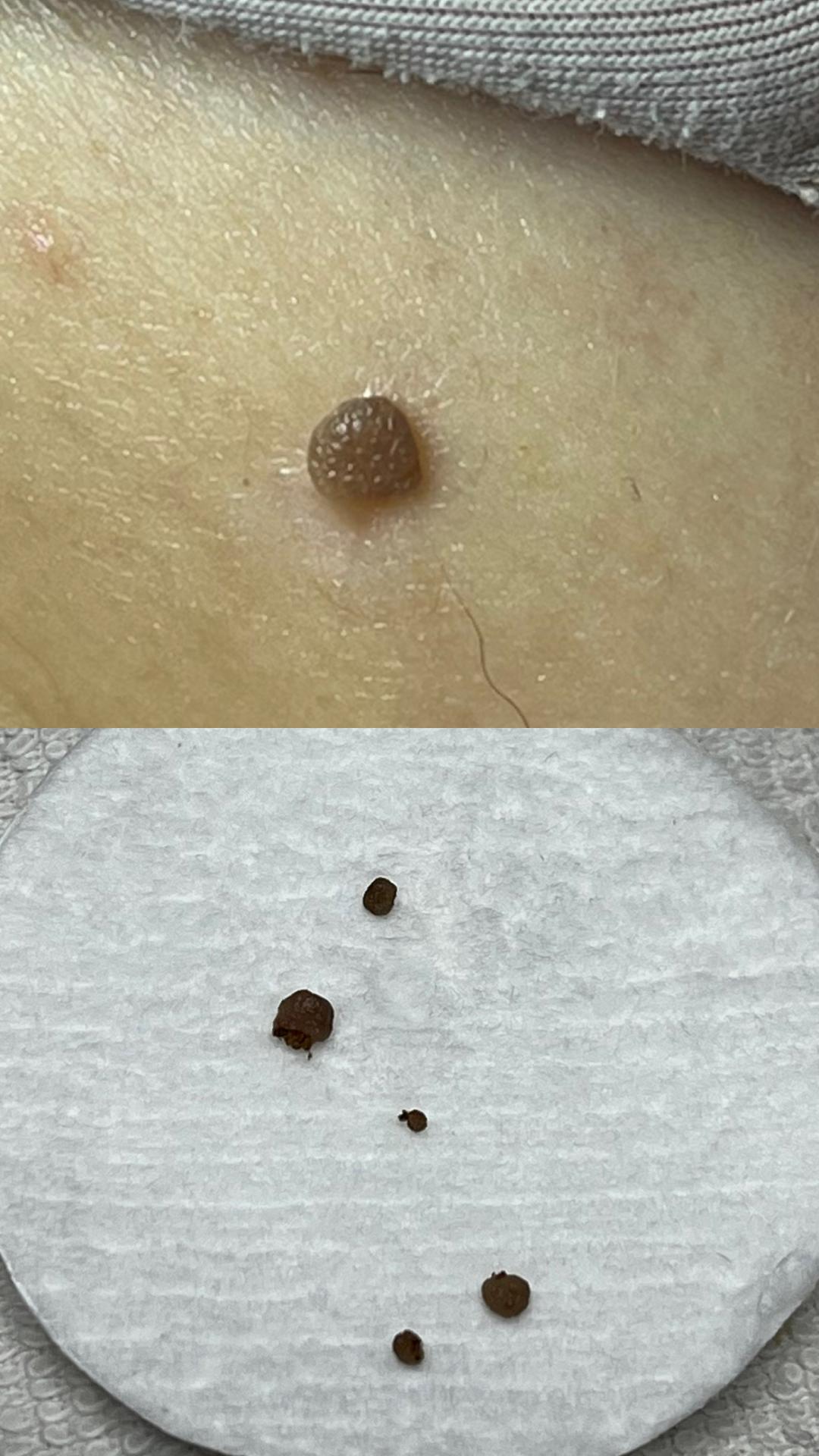 Belle Ana #beograd Tretman lica Phi-Ion tretman - bradavice / papilomi / keratoze / milije / hiperpigmentacija