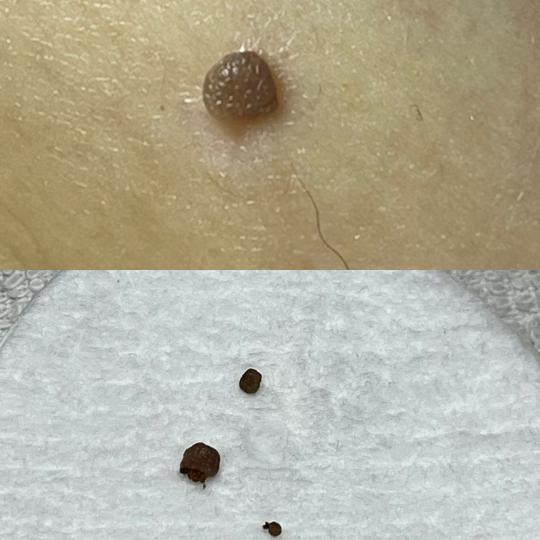 Belle Ana #beograd Tretman lica Phi-Ion tretman - bradavice / papilomi / keratoze / milije / hiperpi