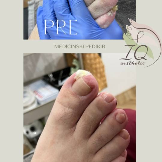IQ aesthetic #beograd Medicinski pedikir Medicinski pedikir