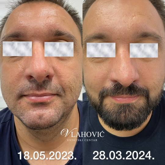 Estetski centar Vlahović #beograd Tretman lica Dermapen - masna koza Najbolji rezultati se postižu