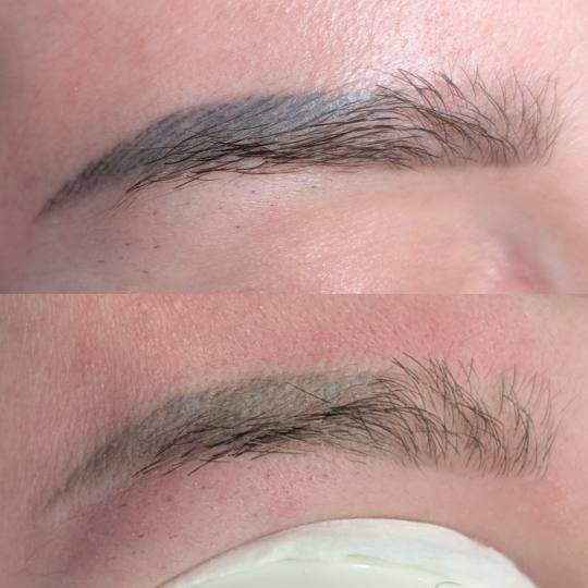 Brow & Glow #novisad Laserski tretmani lica Lasersko uklanjanje obrva Lasersko uklanjanje trajne šm