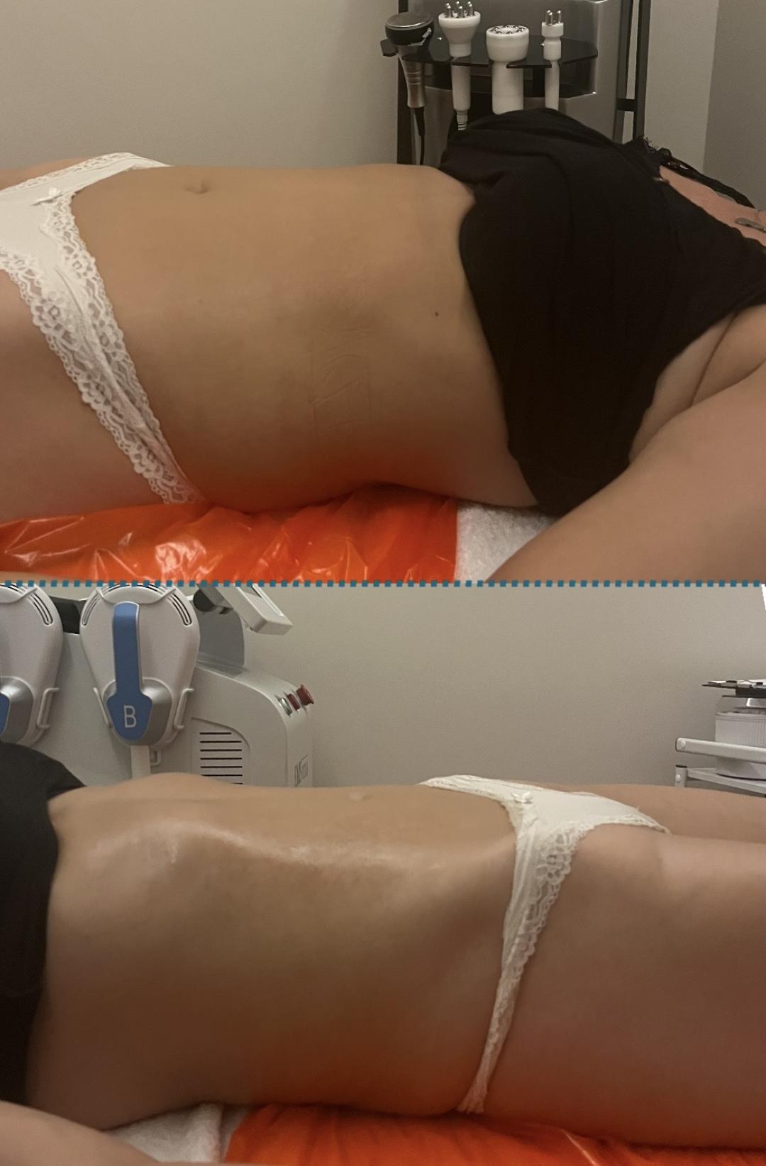Vacum 65 body + limfna drenaža - Diamond beauty, Beograd Anticelulit masaža Masaža Anticelulit masaža, Beograd, Zemun Centar