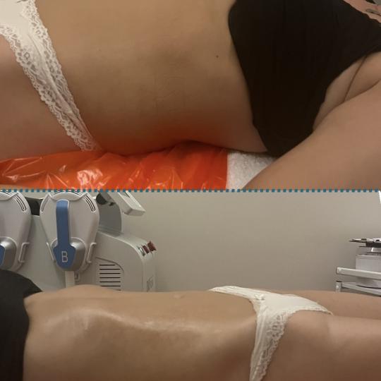 Diamond beauty #beograd Anticelulit masaža Vacum 65 body + limfna drenaža Masaža