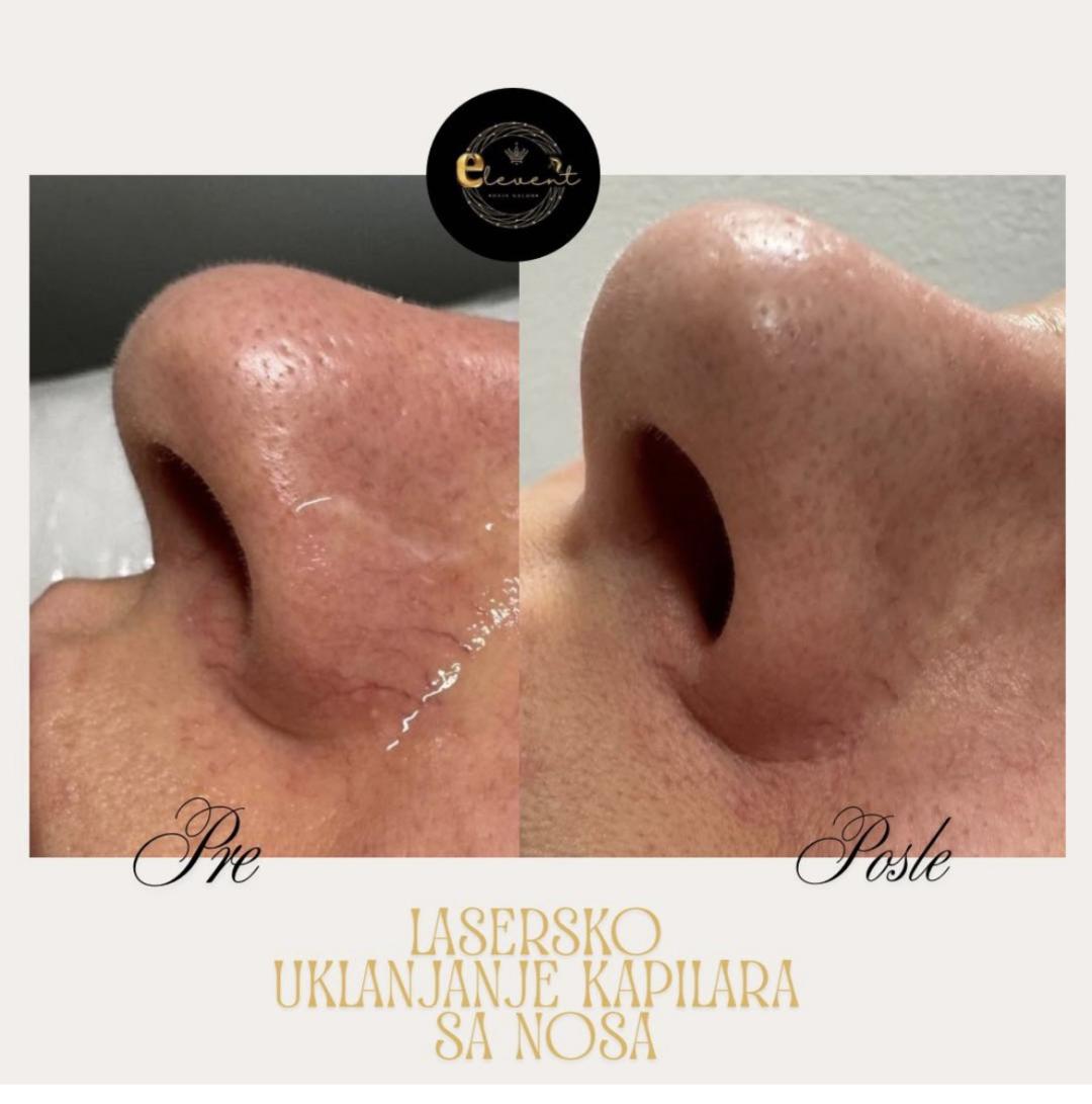 Elevent #beograd Tretmani tela Lasersko uklanjanje kapilara