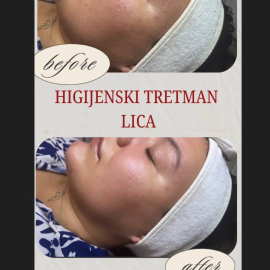 Step up beauty #beograd Tretman lica Higijenski tretman lica