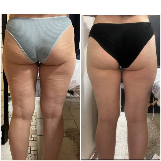 Studio Cocco by Ana #beograd Anticelulit masaža Maderoterapija + vakuum slim - paket od 10 tretmana