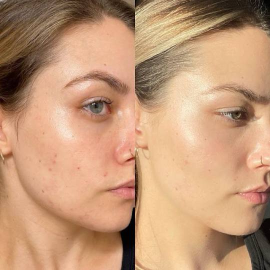 Xenija Beauty Room #beograd Tretman lica Dermapen tretman lica ✨ Derma Pen – put ka savršenoj k
