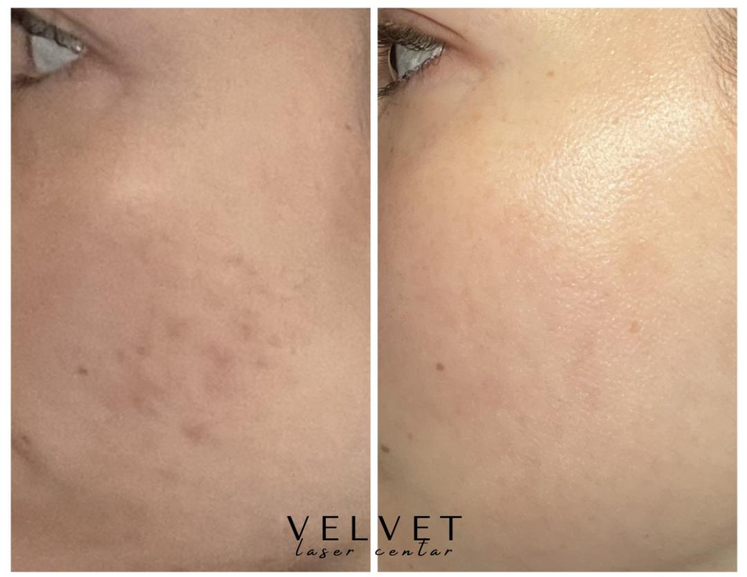 Laserska rejuvenacija - lice - Velvet, Beograd Laserski tretmani lica Lice Laserski tretmani lica, Beograd, Slavija, Autokomanda, Neimar