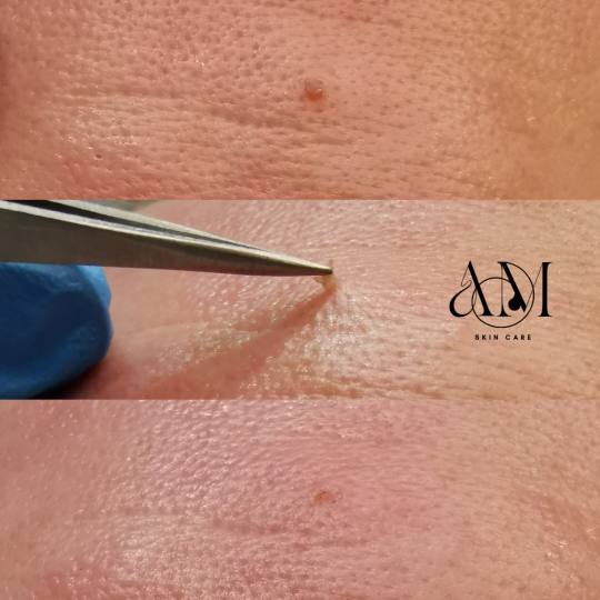 AM BEAUTY STUDIO #odzaci Tretman lica Uklanjanje papiloma