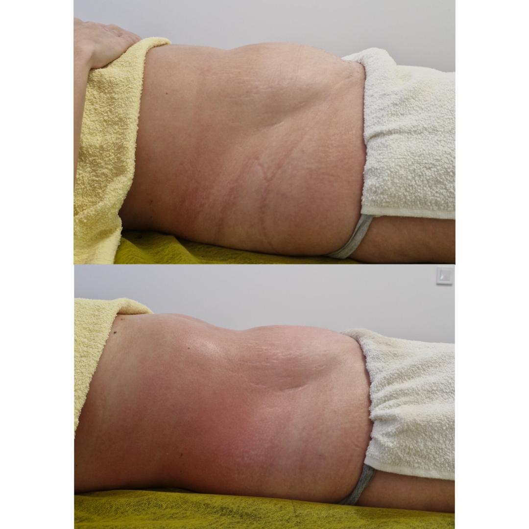 Body shaping PRO - po regiji - Apolona, Beograd Lipomodelovanje Telo Lipomodelovanje, Beograd, Banovo brdo