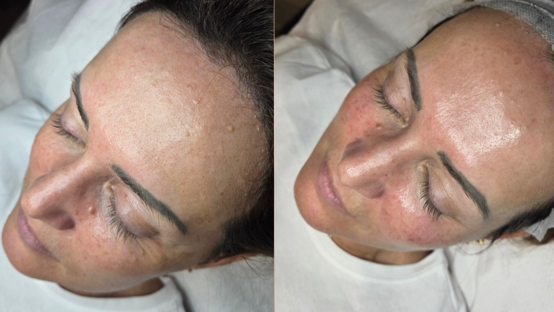Starmedic #beograd Dermaroler i dermapen Holivudski sjaj - Jessner