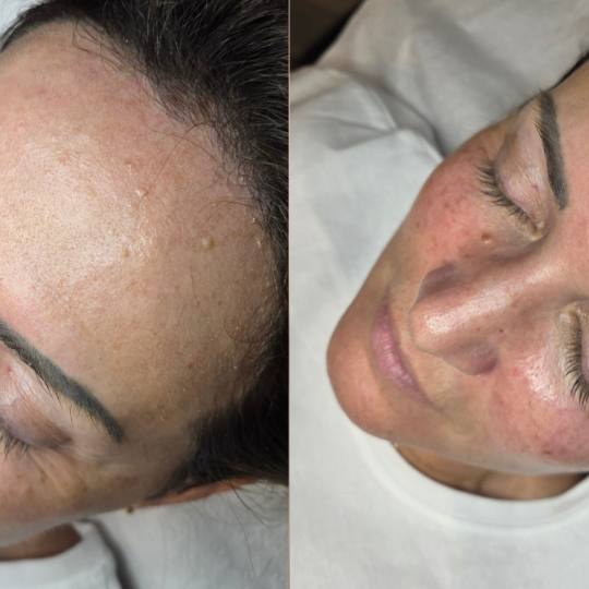 Starmedic #beograd Dermaroler i dermapen Holivudski sjaj - Jessner