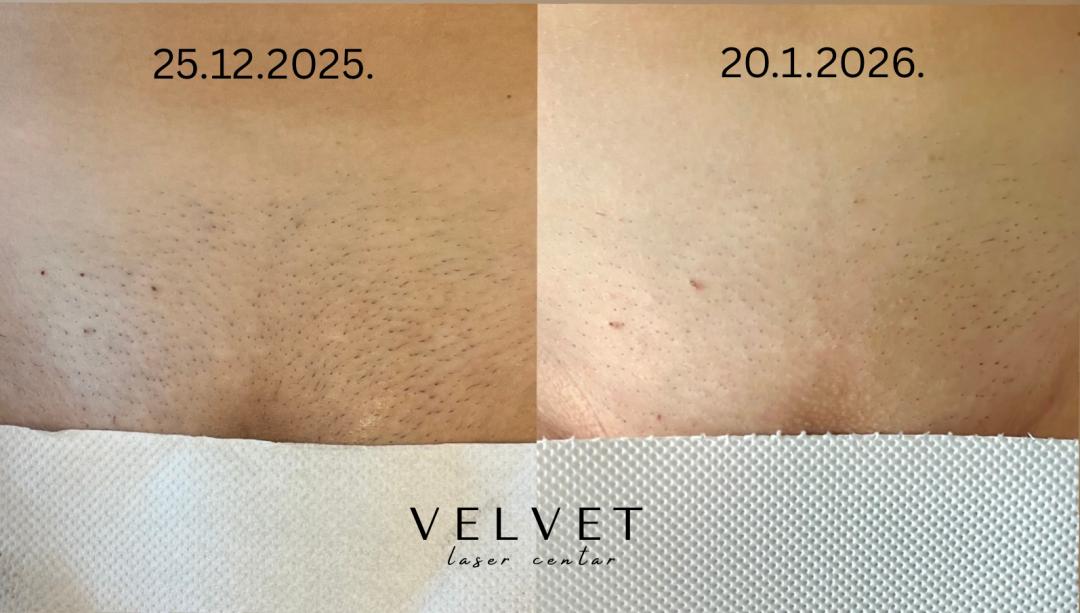 Velvet #beograd Laserska epilacija Brazilska laserska epilacija - za dame