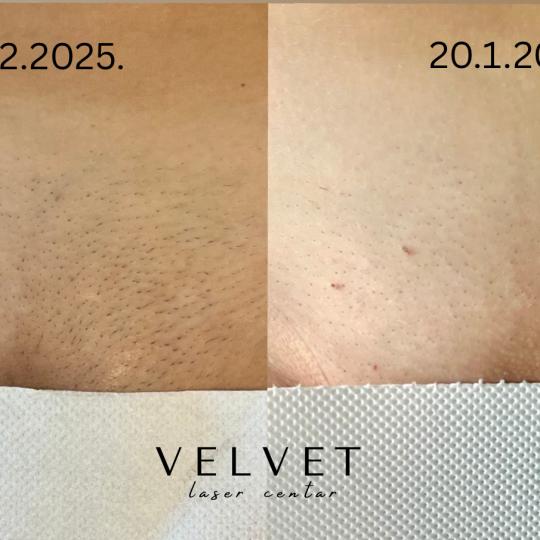 Velvet #beograd Laserska epilacija Brazilska laserska epilacija - za dame