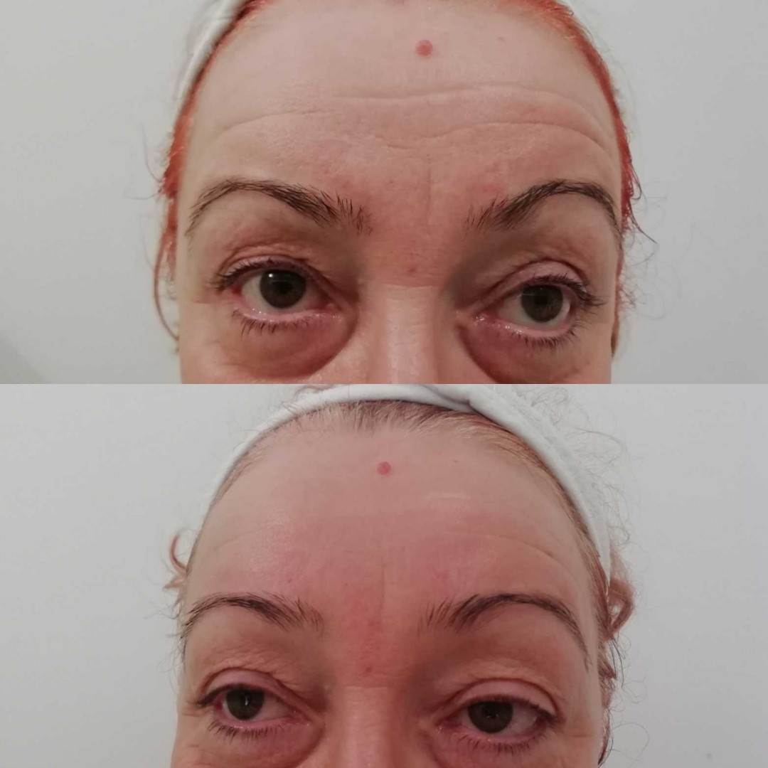 Olja Beauty #beograd Lifting / zatezanje kože HiFu tretman lica - po regiji
