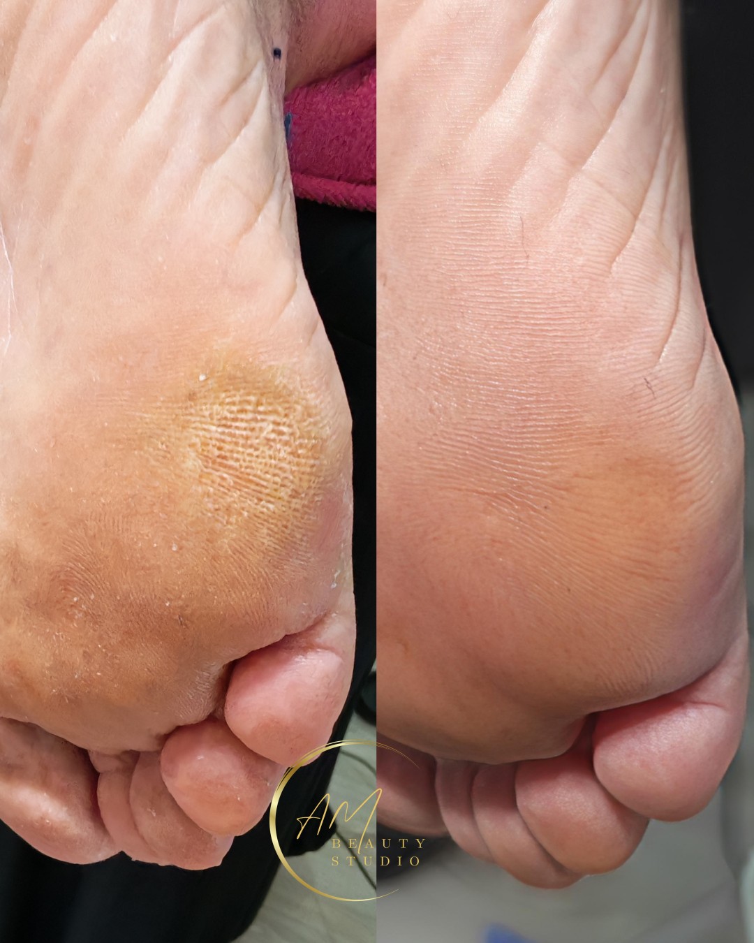 AM BEAUTY STUDIO #odzaci Tretmani tela Aparatni pedikir