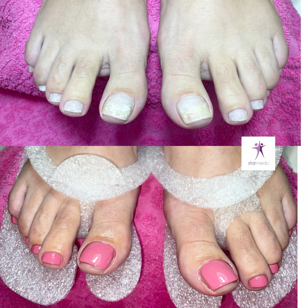 Starmedic #beograd Estetski pedikir Estetski pedikir + trajni lak (ruski aparaturni pedikir)