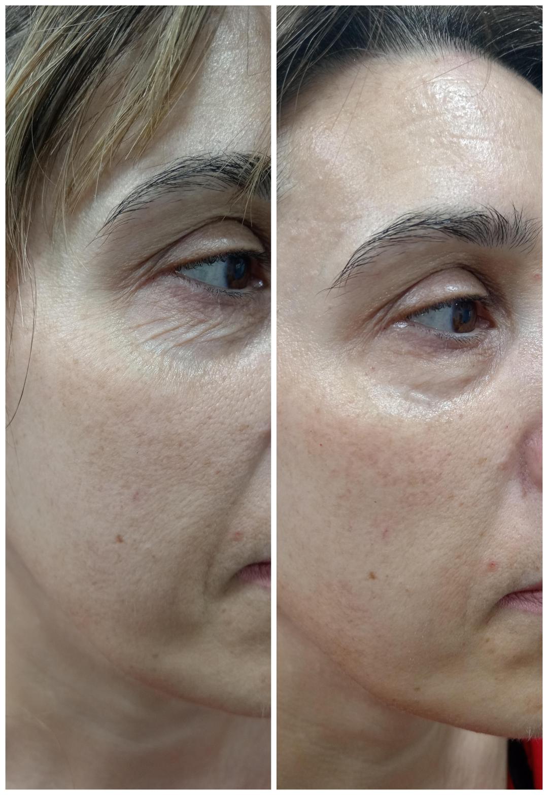 Mesolift tretman lica - Beauty & Fashion, Beograd Tretman lica Lice Tretman lica, Beograd, Mirijevo