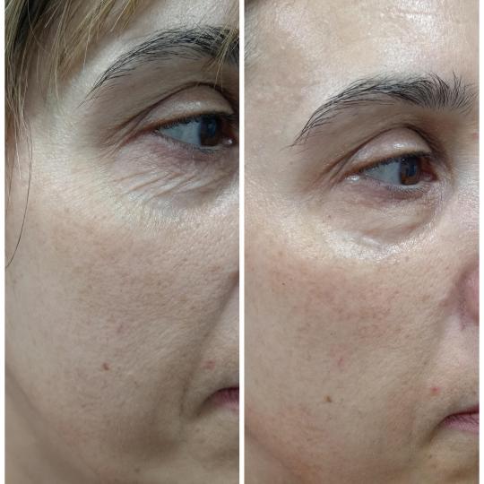 Beauty & Fashion #beograd Tretman lica Mesolift tretman lica ✨ Mezolift – prirodni osveživač k