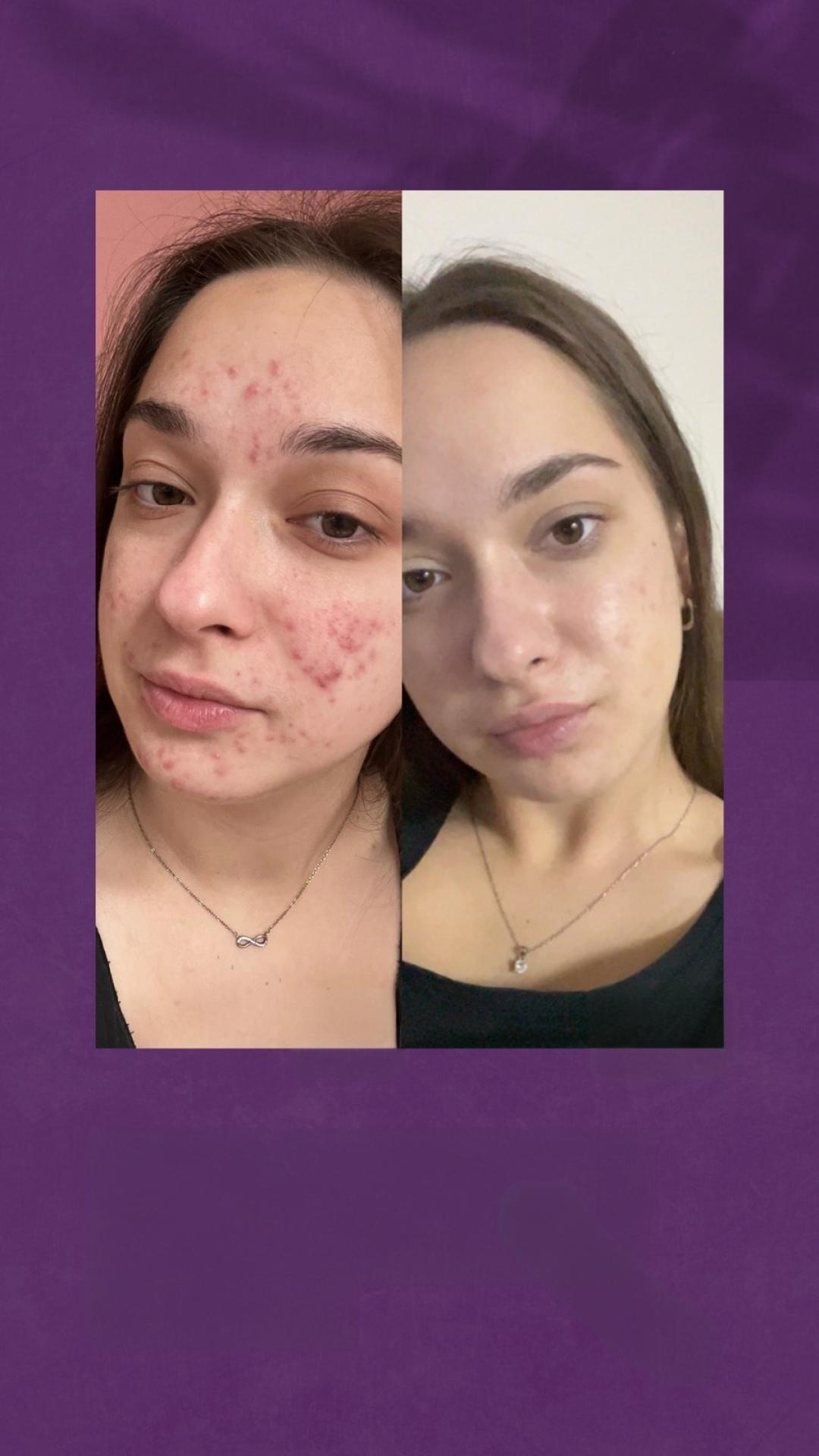 Tretman problematične kože lica - Natural Beauty Lux, Beograd Tretman lica Lice Tretman lica, Beograd, Bežanijska kosa, Bežanija, Ledine, Surčin