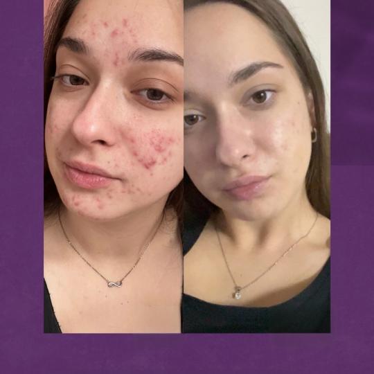 Natural Beauty Lux #beograd Tretman lica Tretman problematične kože lica Tretman problematične ko