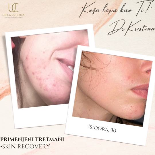 Unica Estetica #nis Tretman lica Skin recovery tretman lica