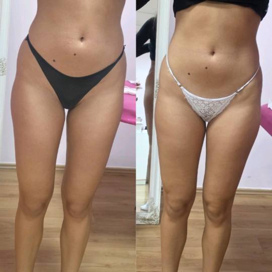 Mademoiselle Natalie studio #beograd Anticelulit LUX 10 maderoterapije+10 limfne drenaze+ brazilske 