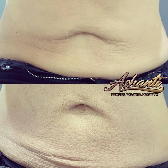 Ashanti Beauty Salon & Academy #beograd Tretman lica Plasma pen - stomak