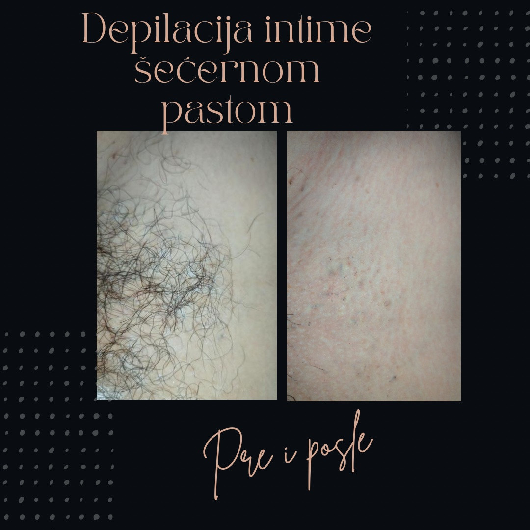 Beauty in Style DM #novisad Depilacija šećernom pastom Intimna depilacija šećernom pastom - za dame