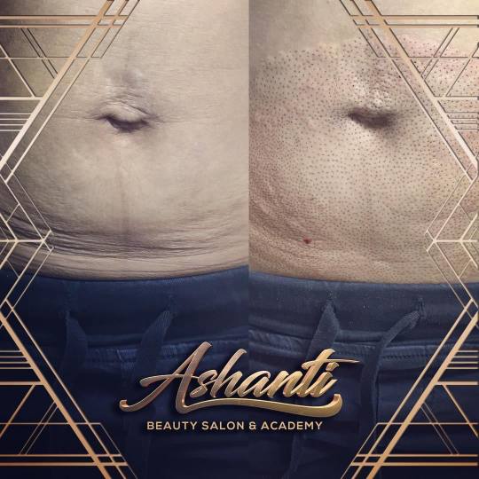 Ashanti Beauty Salon & Academy #beograd Tretman lica Plasma pen - stomak