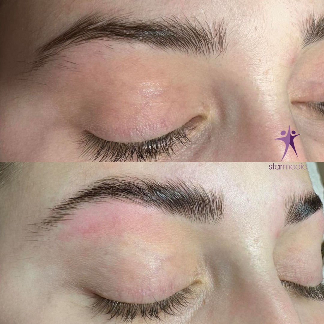 Starmedic #beograd Trepavice Brow lift