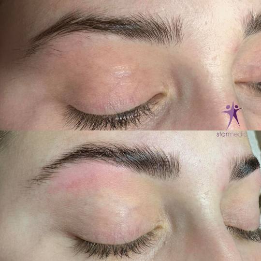 Starmedic #beograd Trepavice Brow lift