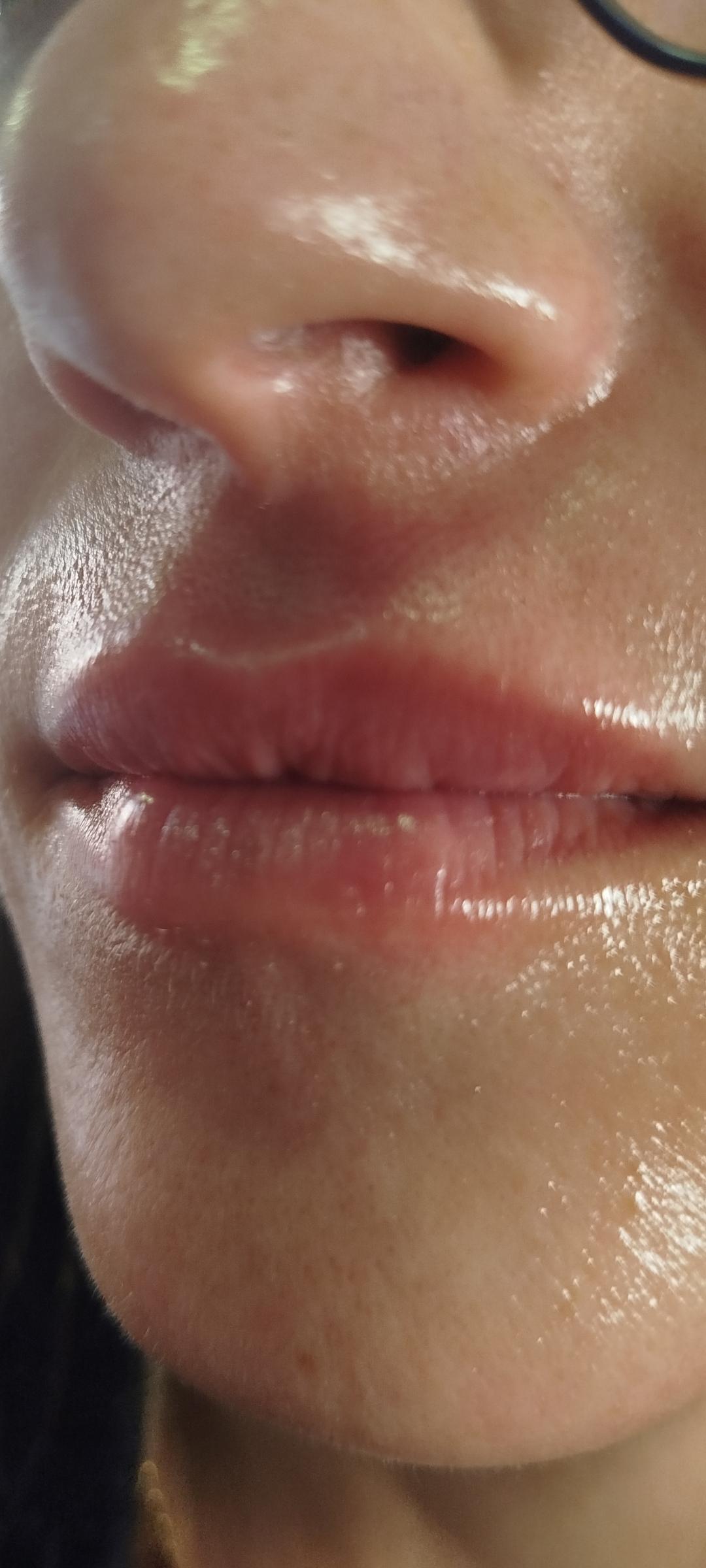 Professional beauty and spa #beograd Mezoterapija lica Hijaluron pen - 1ml