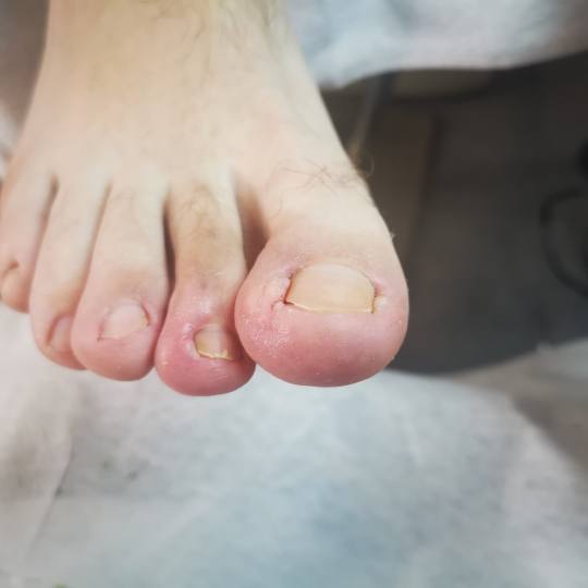 PediMedi - Arena #beograd Medicinski pedikir Intervencija uraslog nokta - jedan nokat