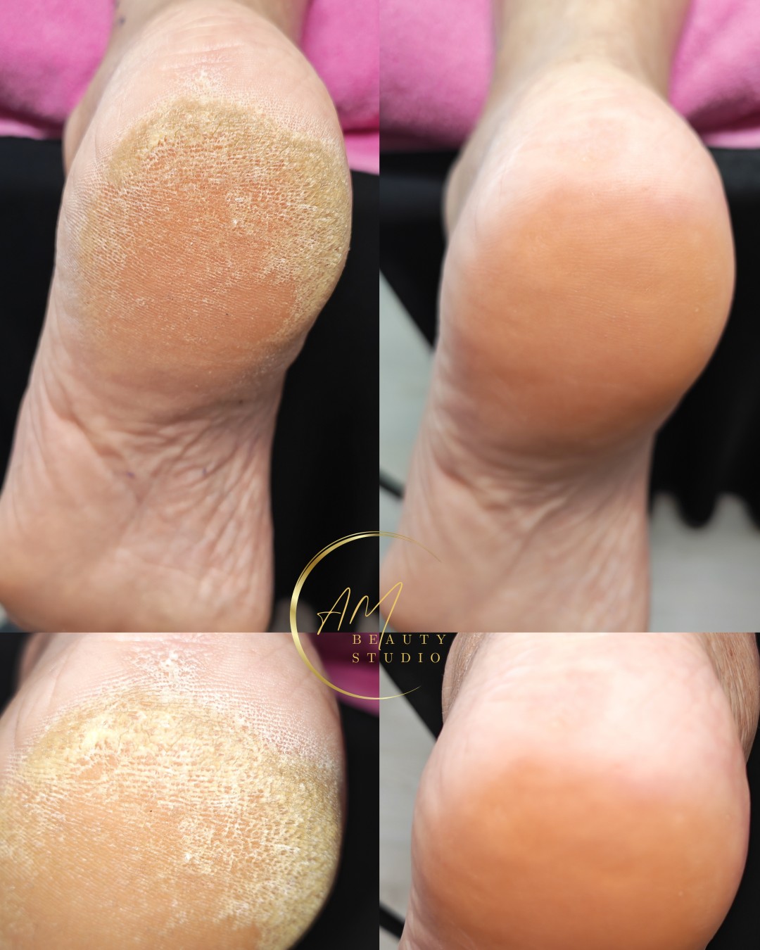 AM BEAUTY STUDIO #odzaci Tretmani tela Aparatni pedikir sa čarapama za hidrataciju