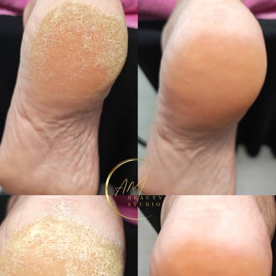 AM BEAUTY STUDIO #odzaci Tretmani tela Aparatni pedikir sa čarapama za hidrataciju Tretmani tela