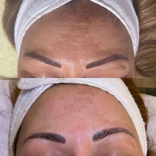 Lancier Beauty Expert #beograd Tretman lica Plazma lift lica - jedna regija