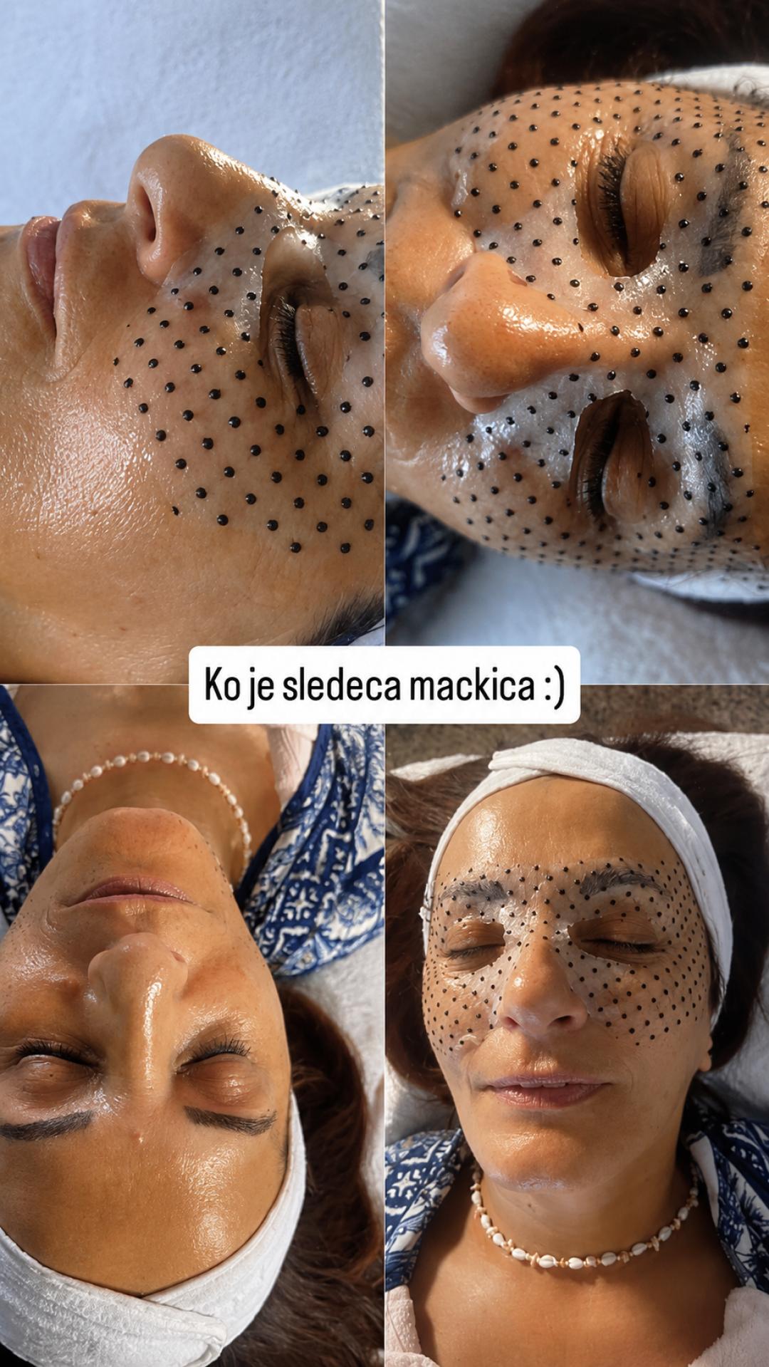 Dermapen eye lift koktel - podizanje kapaka-1 tretman - Professional beauty and spa, Beograd Tretmani protiv bora Lice Tretmani protiv bora, Beograd, Žarkovo, Cerak, Bele vode