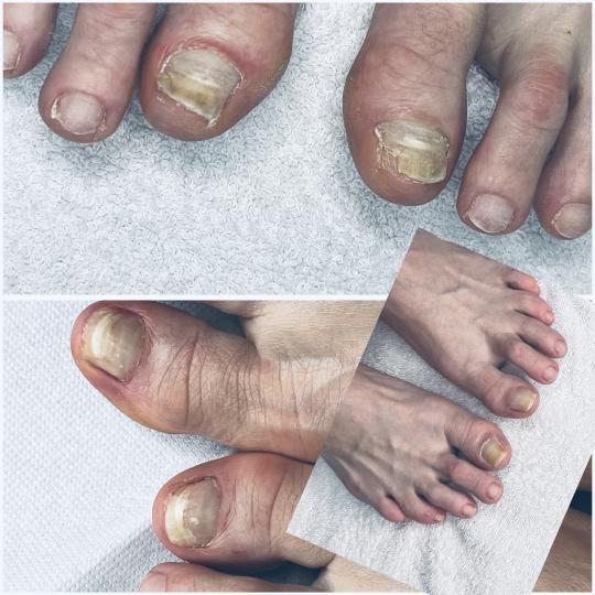 Belle Ana #beograd Tretmani tela Lasersko uklanjanje gljivica noktiju Lasersko uklanjanje gljivica n