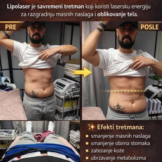 MS Beauty Centar #beograd Mršavljenje Lipolaser Mršavljenje