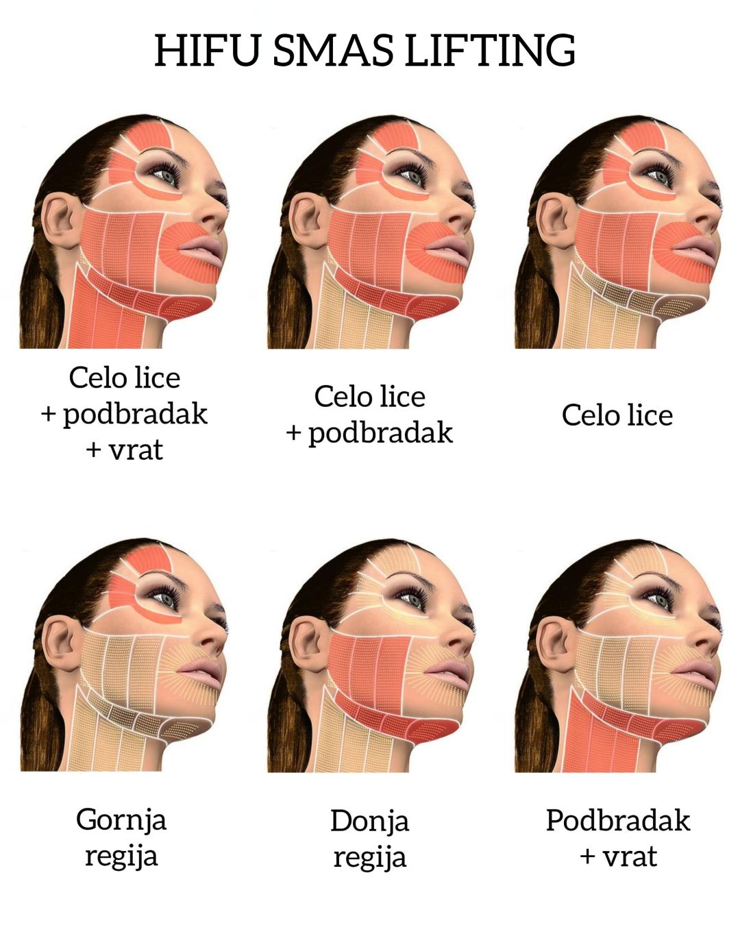 HIFU 7D tretman - lice + podbradak - AM BEAUTY STUDIO, Odžaci Lifting / zatezanje kože Lice Lifting / zatezanje kože, Odžaci, Centar