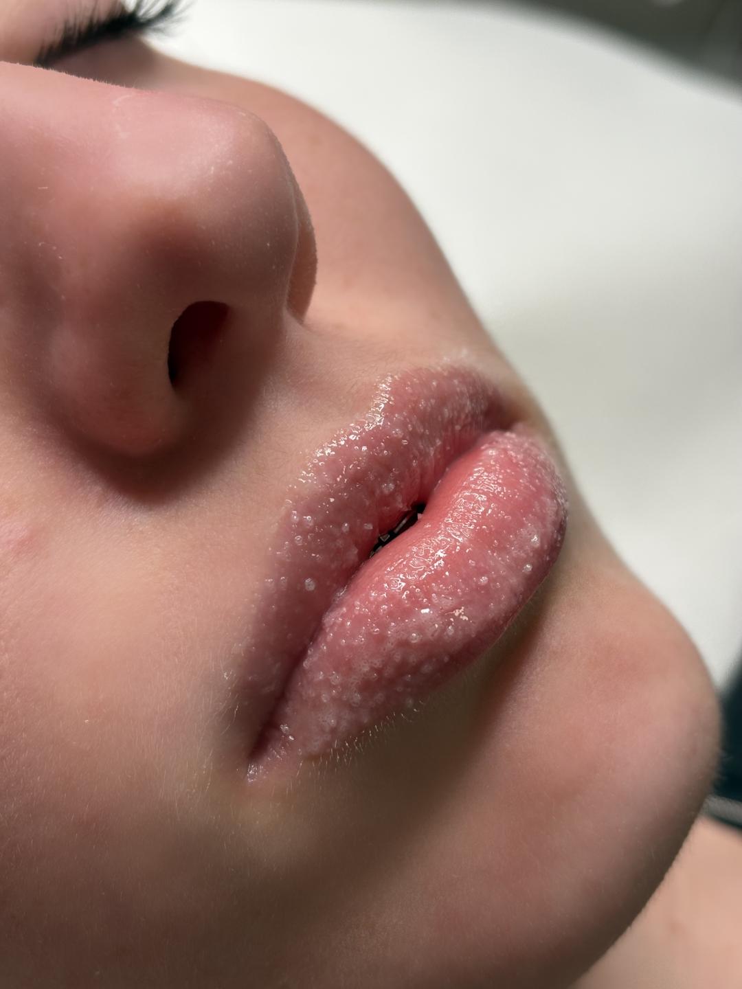 Hydralips-mezoterapija usana hijaluronom - L’Avenue, Beograd Mezoterapija lica Lice Mezoterapija lica, Beograd, Centar, Stari grad, Dorćol