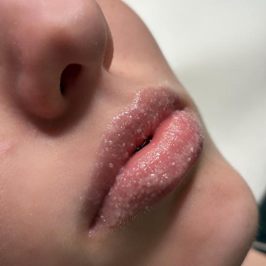 L’Avenue #beograd Mezoterapija lica Hydralips-mezoterapija usana hijaluronom