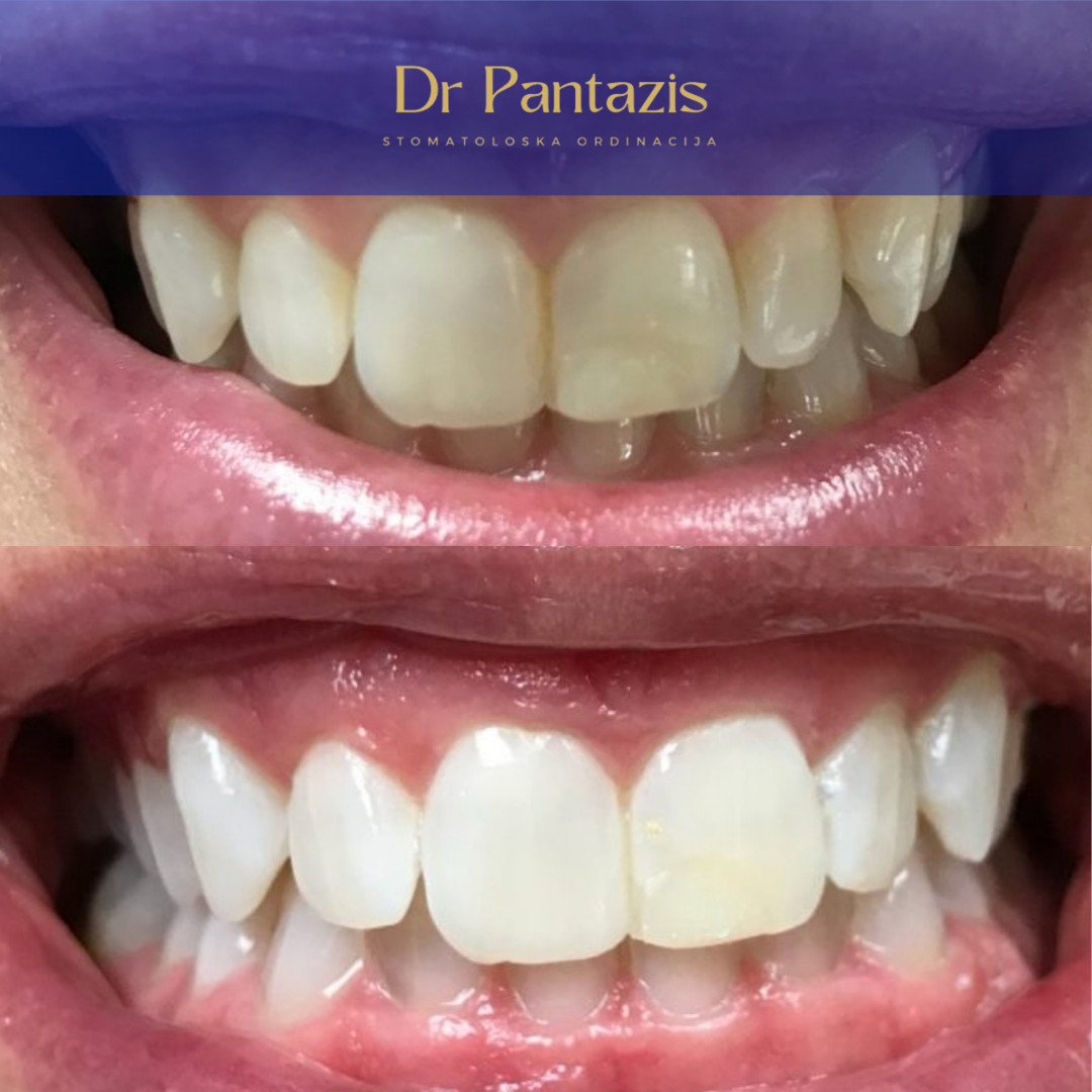 Dr Pantazis - Dental & Beauty Clinic #beograd Zubi Lasersko Profesionalno Izbeljivanje Zuba